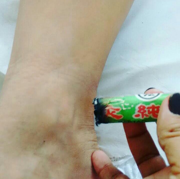 Moxaterapia: Terapia Tradicional Chinesa